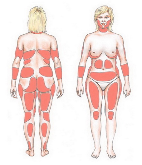 Коррекция фигуры - жировые ловушки - локальные жировые отложения