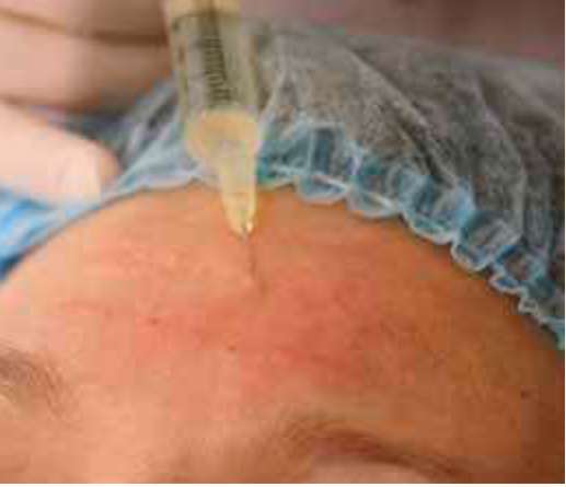 мезотерапия - лобные морщины