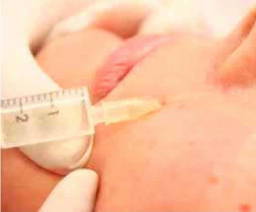 мезотерапия - техника проведения