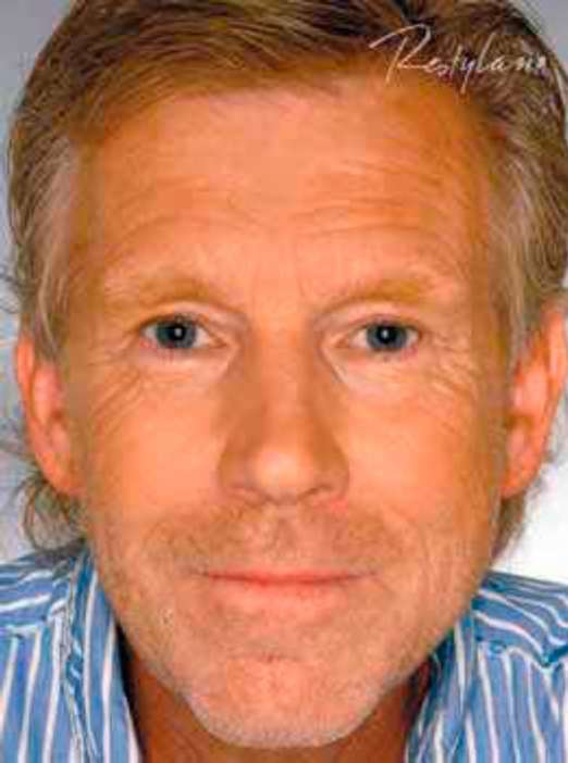 рестилайн - до процедуры