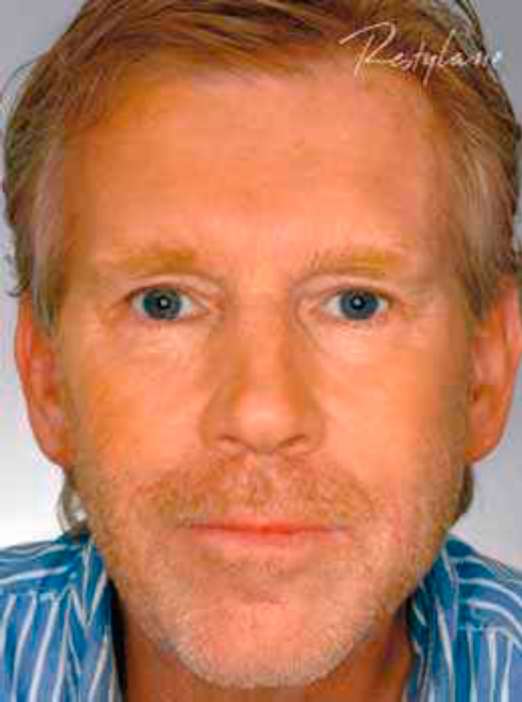 рестилайн - после процедуры