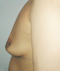 грудь до Beautytek-терапии