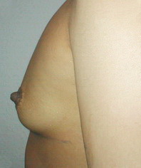 грудь после процедуры Beautytek-терапии