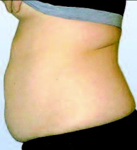 живот до Beautytek-терапии