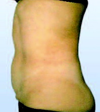 живот после 12 процедур Beautytek-терапии