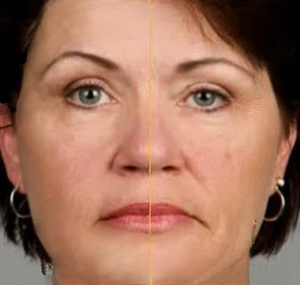 Ботокс-лифтинг