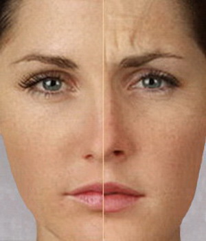 Ботокс - коррекция морщин