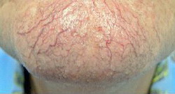 Расширенные сосуды на лице - подбородок. До лечения.