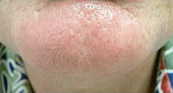 После удаления сосудов лазером