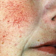 расширенные сосуды лица - до лечения