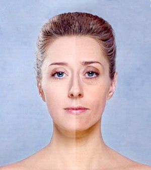 LPG-массаж лица