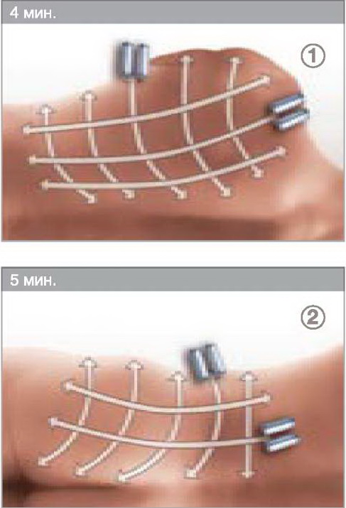 LPG - Эндермо-Моделирование