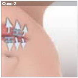 восстановление контура губ - LPG