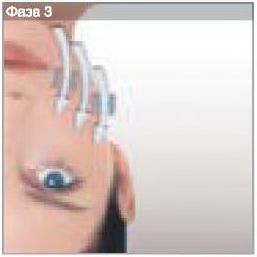 LPG - моделирование скуловой области