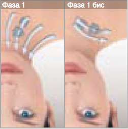 LPG - укрепление кожи шеи и декольте