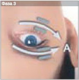 LPG - дренаж для выведения токсинов - фаза 3