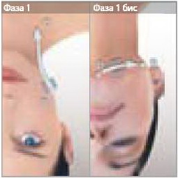 LPG - дренаж для выведения токсинов