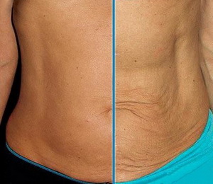 дряблая кожа живота