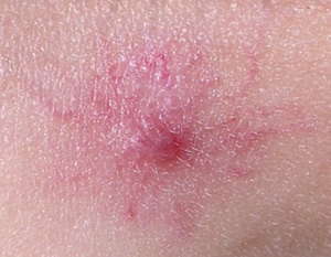 Сосудистая звездочка - увеличение