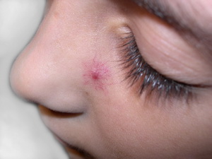 Сосудистая звездочка