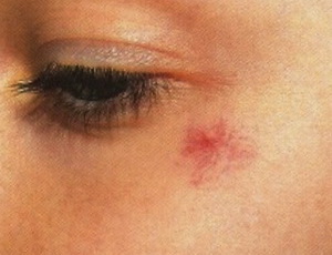 Сосудистая звездочка на лице