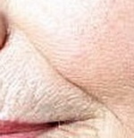 глубокая морщина