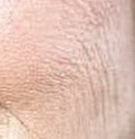 Поверхностные морщины