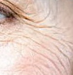 Средне-глубокие морщины