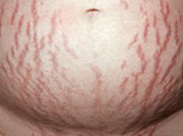 стрии на животе