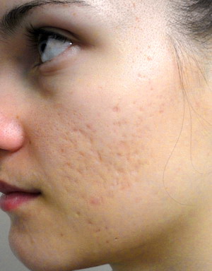 атрофические рубцы после угревой болезни