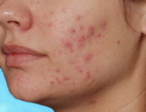 красные пятна после угрей