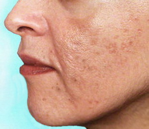 пигментные пятна после угрей